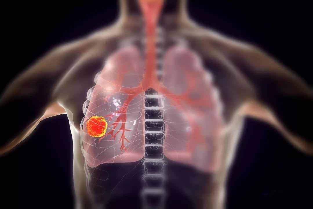 2020年新发布肿瘤资讯:“全球肺癌关注月”,这些情况请注意!可能是癌细胞在转移!-易加医