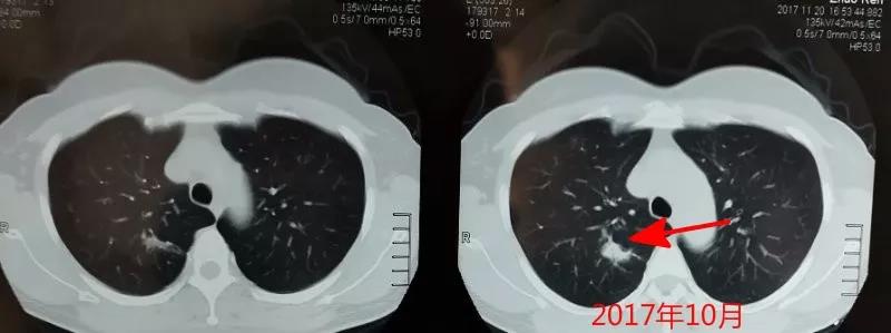 肺癌诊断|体检发现肺部结节怎么办，会不会是肺癌？