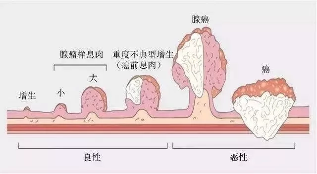 肠癌预防:有多可怕!80%肠癌发现时已是晚期.-易加医