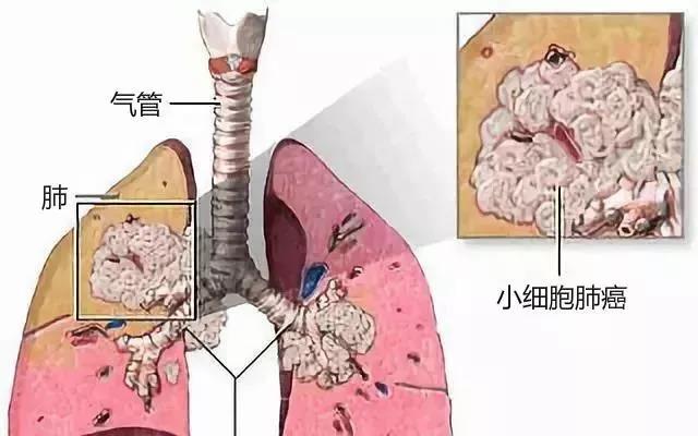 肺癌治疗 | 一文读懂，小细胞肺癌该如何选择免疫治疗