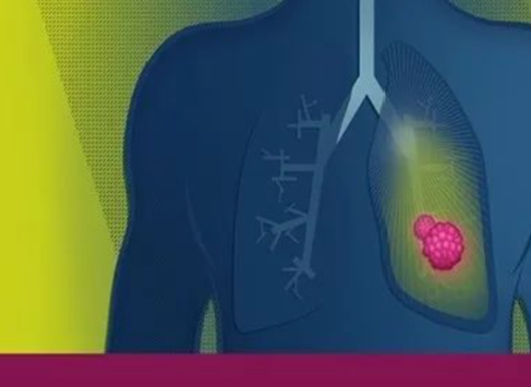重大突破 | 研究证明泰瑞沙用于EGFR+非小细胞肺癌术后治疗有效！